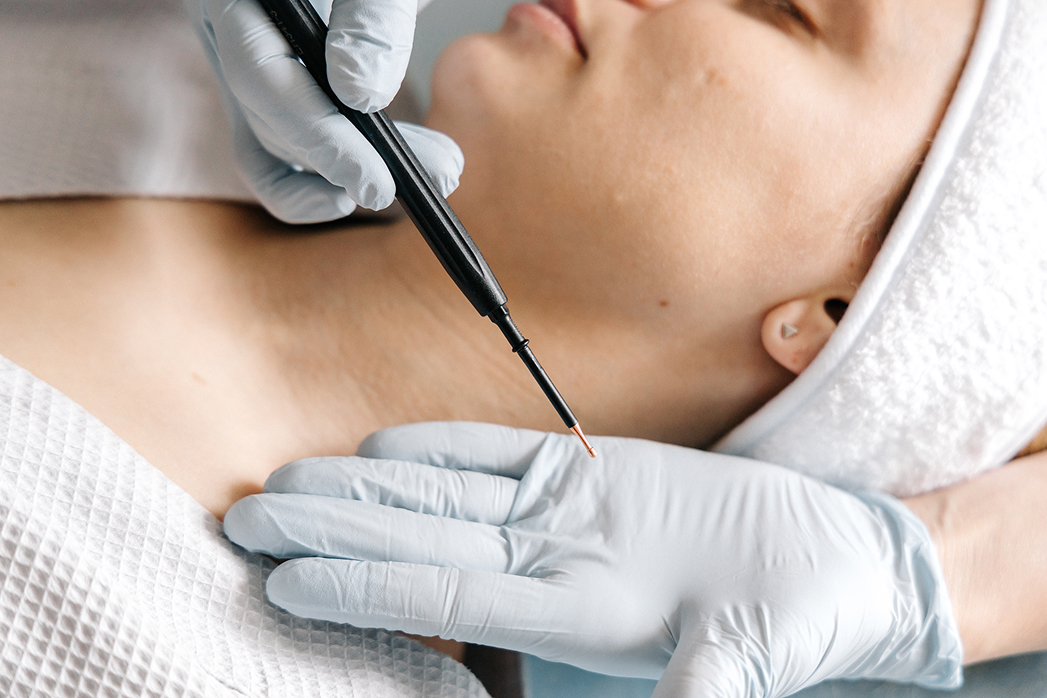 Удаление новообразований - изображение